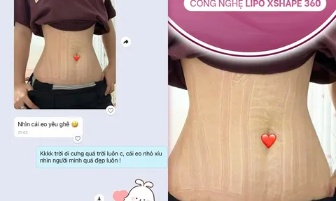 LIPO XSHAPE 360: Xu hướng tạo dáng đa tầng bằng công nghệ ít xâm lấn được nhiều khách hàng quan tâm