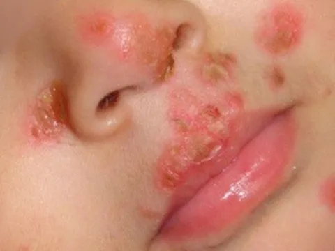 Bé chốc lở quanh mũi và mắt sau khi bôi dầu gió: Chuyên gia chỉ rõ nguyên nhân