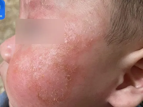 Kiêng tắm cho trẻ mắc Covid-19, hậu quả bị viêm da nặng: Bác sĩ cảnh báo