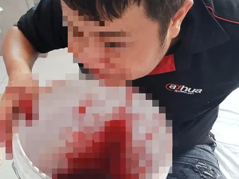 Vỡ dị dạng mạch máu, chàng trai ôm xô máu mũi chạy vào bệnh viện cấp cứu