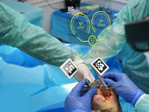 Lần đầu tiên đưa công nghệ thực tế ảo vào thay khớp nhân tạo tại Việt Nam