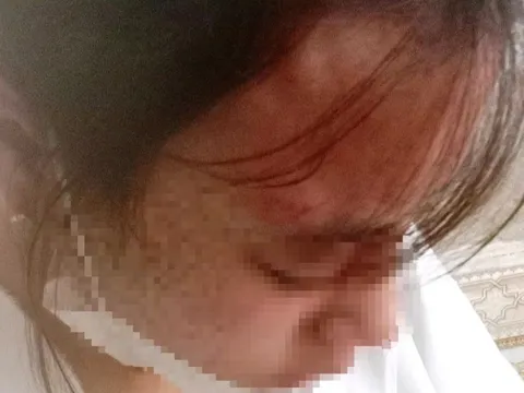 Đến quán tạp hóa mua kim khâu, nữ sinh lớp 10 bị chủ quán đánh đập dã man