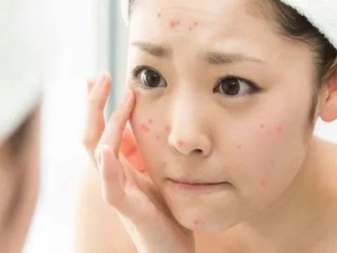 Tuyệt chiêu tẩy tế bào chết cho da mụn đúng cách, không tổn thương da