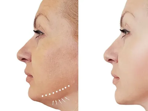 Nữ bệnh nhân suýt đứt cổ vì tiêm tan mỡ