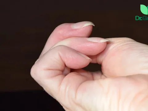 Ngón tay có biểu hiện này báo hiệu sớm căn bệnh ung thư có tỷ lệ mắc hàng đầu Việt Nam