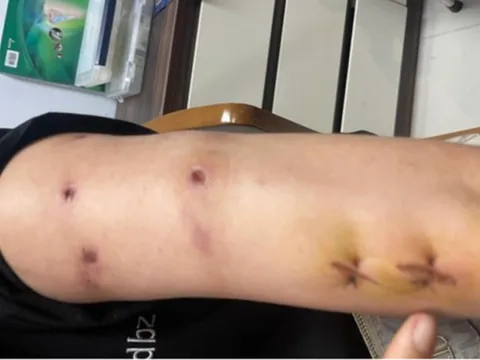 Người phụ nữ bị thủng hàng chục lỗ trên cơ thể sau khi tiêm tan mỡ