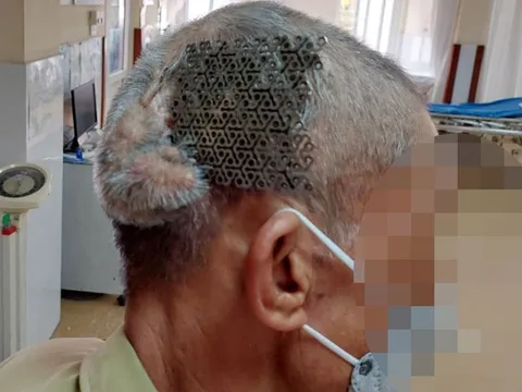 Người đàn ông nhập viện với tấm titatium hở trên sọ não