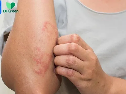 Nhiều F0 viêm da vì kiêng tắm gội: Chuyên gia cảnh báo tiềm ẩn nhiều nguy hiểm