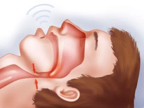 Mắc Covid-19, người đàn ông hạ SpO2 đến mức nguy hiểm: Bác sĩ cảnh báo "sát thủ" khi ngủ