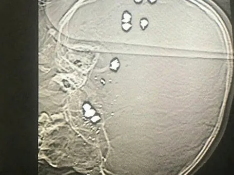 Bé trai 6 tuổi bị 11 viên đạn bi găm vào đầu