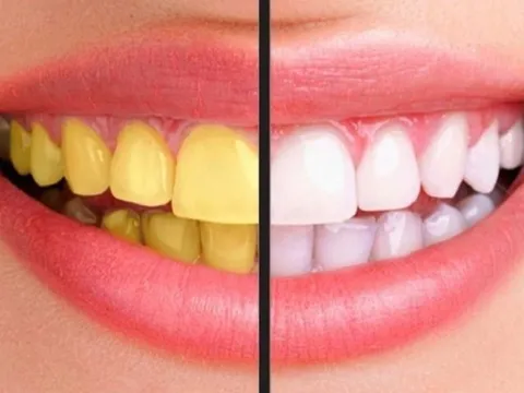 Mê cà phê nhưng không muốn răng bị ố vàng thì áp dụng mẹo hay này