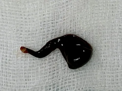 Đi tắm suối, người đàn ông bị con đỉa 5 cm ‘kí sinh’ trong mũi