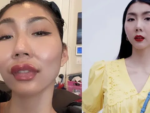 Ngọc Quyên gây sốc với hình ảnh gương mặt lạ lẫm, môi má sưng húp khó nhận ra