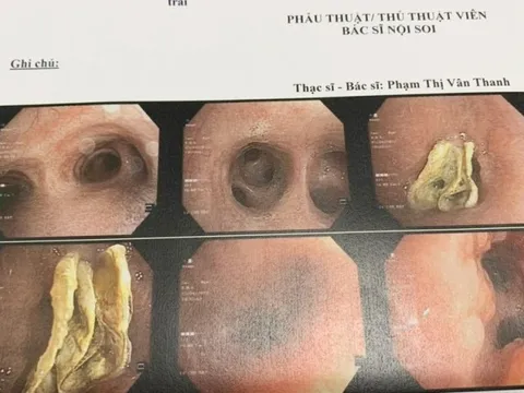 Bác sĩ cảnh báo nguy cơ tử vong vì nuốt phải dị vật vào phổi