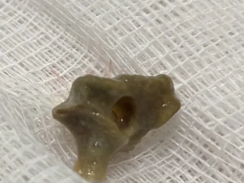 Ho dai dẳng suốt một năm, tưởng do Covid-19, đi khám mới phát hiện 'thủ phạm' bất ngờ