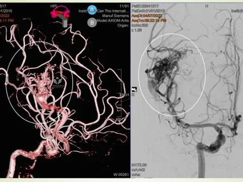 Bé trai 11 tuổi suýt mất mạng vì đột quỵ: BS cảnh báo dấu hiệu cha mẹ không được bỏ qua