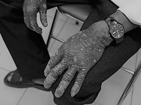 Bị thuốc diệt cỏ đổ vào người, người đàn ông không đi khám, bị ảnh hưởng nặng nề