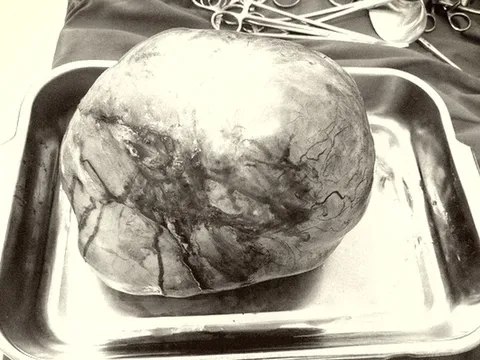 Đi khám vì bụng to, khó thở, người phụ nữ bất ngờ khi phát hiện thủ phạm 5,5kg trong bụng