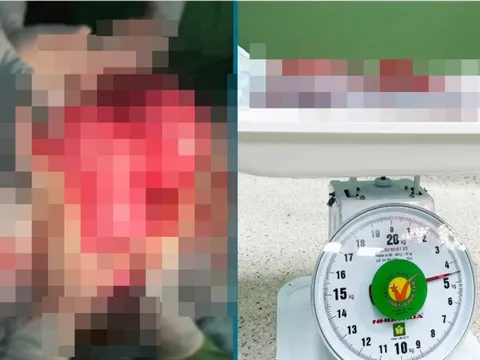 "Sợ dao kéo", người phụ nữ để khối u nặng gần 5kg, chèn lên nội tạng