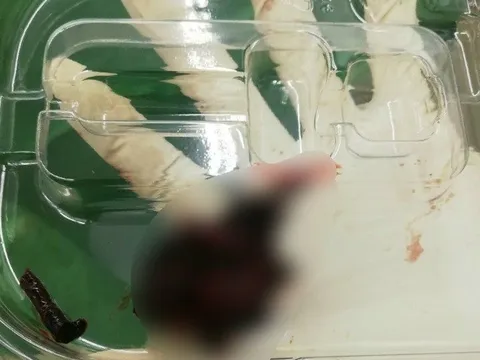 Cứu sống cụ ông 80 tuổi bị tắc động mạch cánh tay trái do cục máu đông