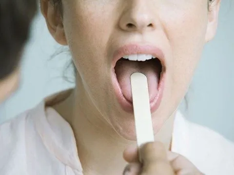 6 bất thường ở lưỡi cảnh báo bệnh tật nhưng nhiều người "ngó lơ"