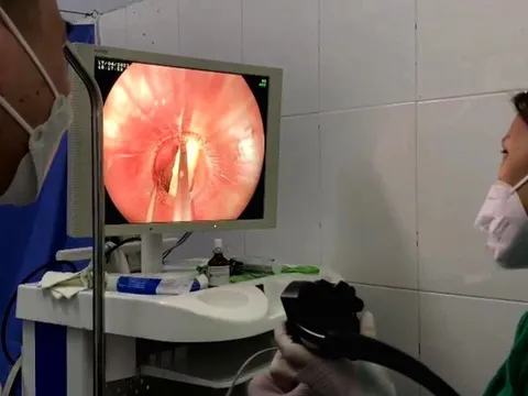Gắp mảnh xương gà cắm vào thực quản bệnh nhân