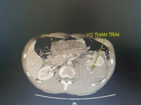 Ca "cứu thận" ngoạn mục cho một bệnh nhân 20 tuổi bị vỡ thận