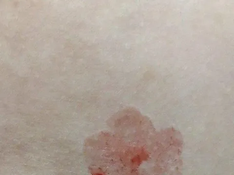 Bé gái 10 tuổi xuất hiện "mồ hôi máu", hiện tượng cực kỳ hiếm gặp