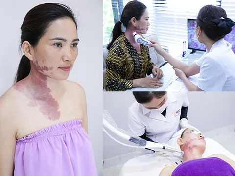 Chàm bớt có nguy hiểm không, điều trị thế nào?