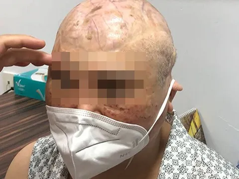 Khuôn mặt biến dạng của người phụ nữ bị tai nạn máy nổ lúc 12 tuổi