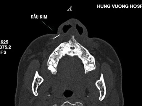 "Phát hoảng" với hình ảnh chụp cây kim gãy trong má bệnh nhân đi thẩm mỹ