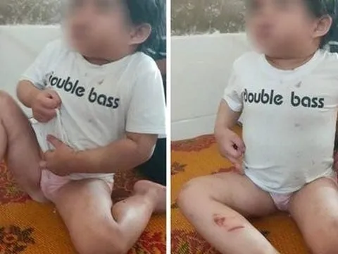 Nghi bé 4 tuổi bị bạo hành, bác sĩ báo công an vào cuộc điều tra