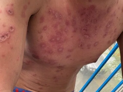 Người đàn ông lở loét khắp người vì căn bệnh cả thế giới mới tìm ra 95 ca