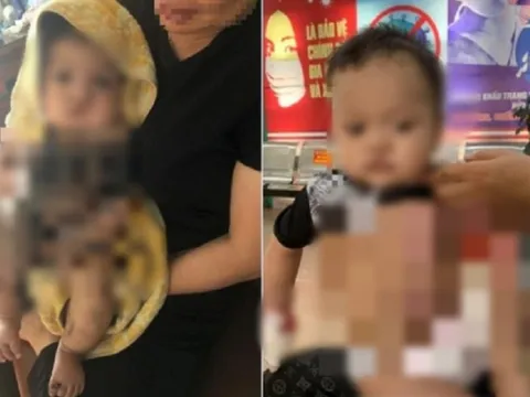 Bé 6 tháng tuổi bị chảy mủ nặng do gia đình đắp thuốc nam chữa bỏng