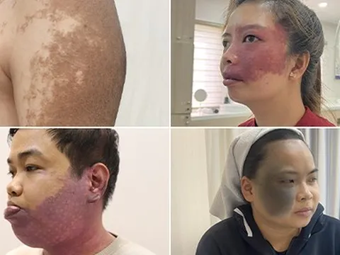 Chàm bớt chỉ có thể chữa được bằng tổ hợp laser công nghệ cao?