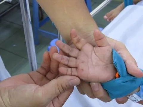Bệnh tay chân miệng vào mùa: Những dấu hiệu CẢNH BÁO ĐỎ cha mẹ cần biết và đề phòng