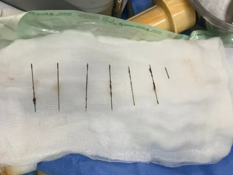 Lấy 7 chiếc kim trong lồng ngực người phụ nữ 28 tuổi