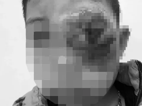 Cậu bé dân tộc Thái mang khối u trên mắt suốt 9 năm khiến mặt biến dạng