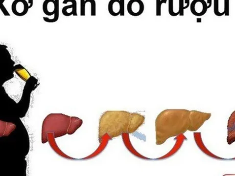 Căn bệnh cực nguy hiểm tàn phá gan ở những người lạm dụng bia rượu: Làm cách nào để phòng?