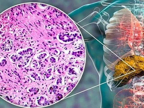 Vàng da, mệt mỏi, chán ăn… Cẩn thận với xơ gan do rượu