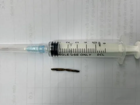 Cứu sống bệnh nhân tai nạn lao động hy hữu với vết thương ở tim