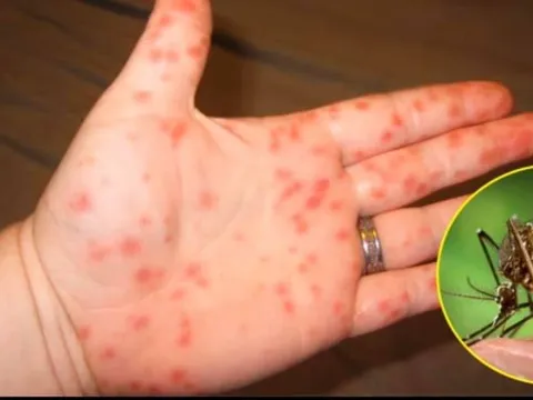 4 giai đoạn của bệnh sốt xuất huyết: Giai đoạn 3 cần chú ý vì dễ nguy hiểm