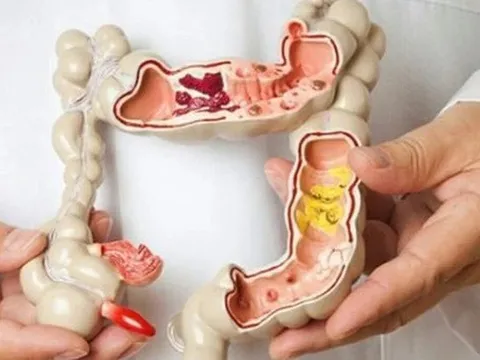 Trào lưu tháo thụt đại tràng để 'thải độc': Bác sĩ cảnh báo không phải ai cũng nên làm