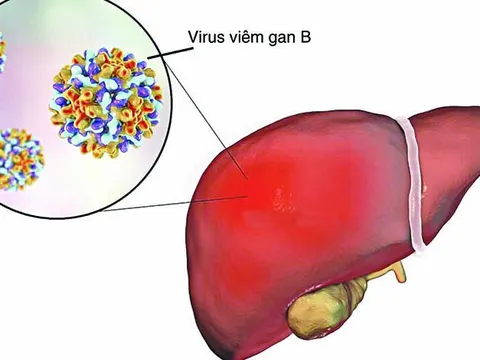 Sở Y tế TP HCM khuyến cáo tình trạng trẻ mắc viêm gan cấp chưa rõ nguyên nhân
