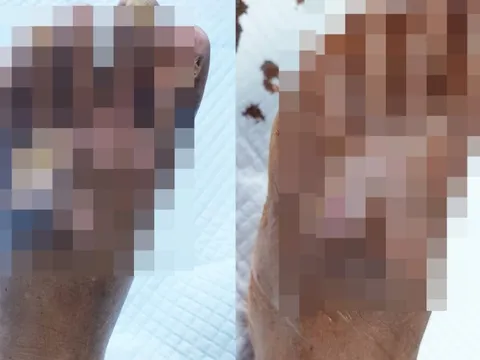 Người đàn ông suýt mất chân do tắc mạch máu hậu COVID-19