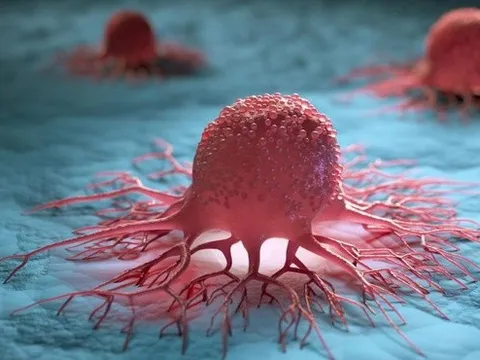 Bác sĩ mách cách phát hiện sớm bệnh ung thư, khuyến cáo cách giảm tới 50% nguy cơ mắc bệnh