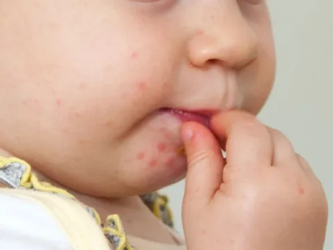 Bệnh tay chân miệng: Nguyên nhân, triệu chứng và các biện pháp phòng ngừa