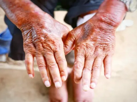 5 dấu hiệu trên da cảnh báo bệnh thận