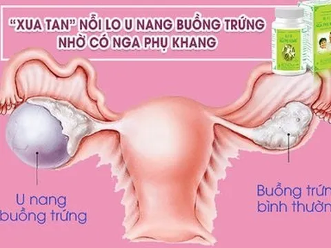 “Xua tan” nỗi lo u nang buồng trứng nhờ có Nga Phụ Khang