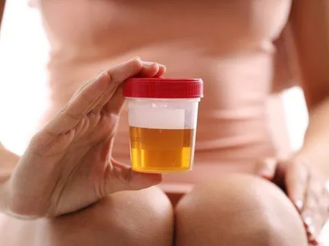 Màu sắc nước tiểu bất thường là cảnh báo của nhiều bệnh nguy hiểm